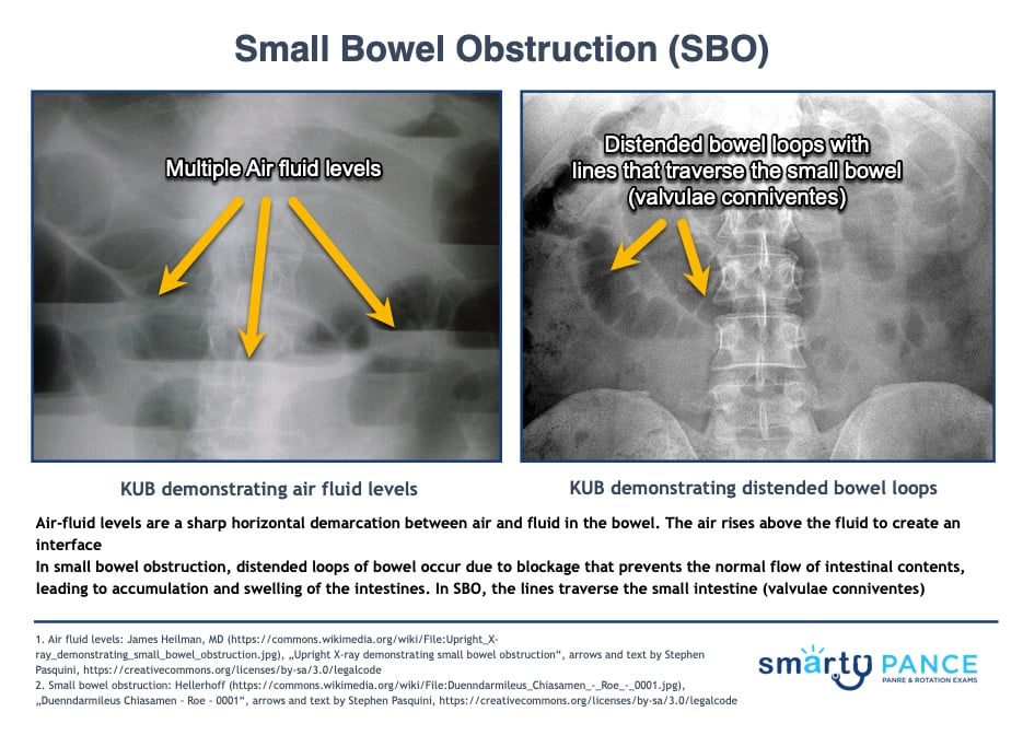 Small Bowel Obstruction Demonstrating Air Fluid Levels and Dilated Loops of Bowel