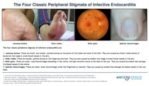 The Four Classic Peripheral Stigmata of Infective Endocarditis