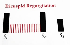 Tricuspid-Regurgitation-Waveform