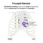 Tricuspid Stenosis (TS) Murmur Auscultation