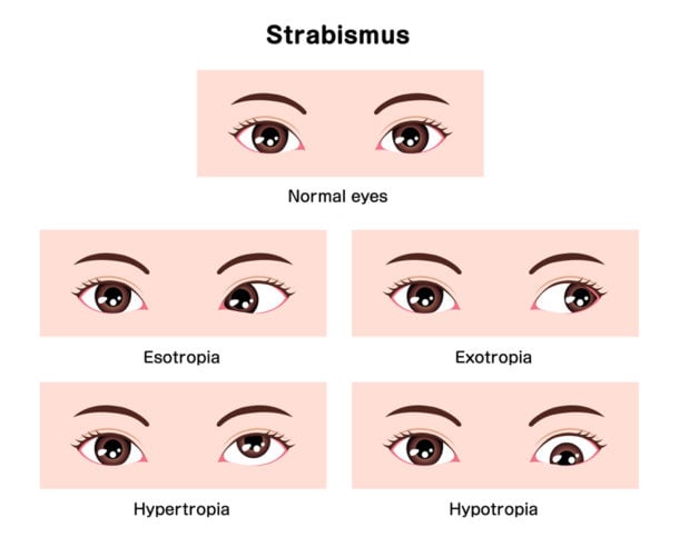 Strabismus | EENT Content Blueprint - Smarty PANCE | PANRE