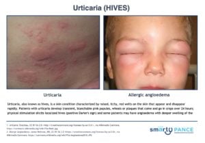 Urticaria (HIVES)