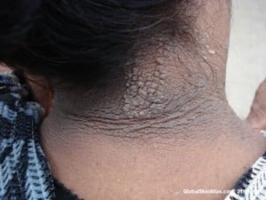 Acanthosis nigricans - Velvety-like thickening of the neck