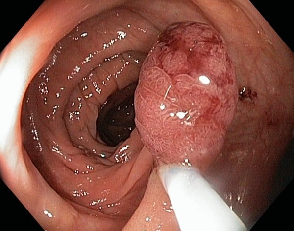 Tubular adenoma in the descending colon - endoscopic polypectomy
