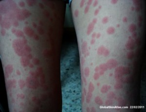 Erythema multiforme