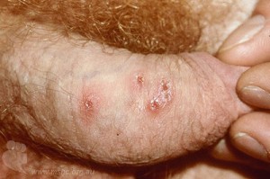 Genital Herpes Simplex