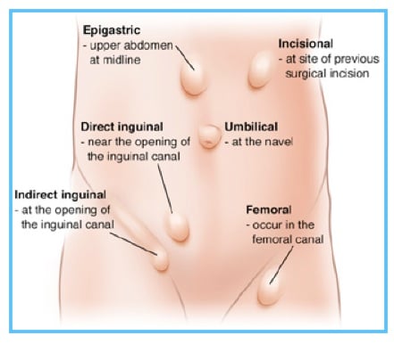 location of hernias