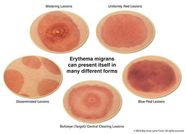 erythema-chronicum-migrans