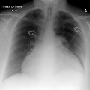 Pericardial effusion with "water bottle sign"