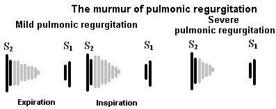 pulmonic valve waveform