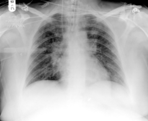 Chest radiograph from a patient with viral pneumonia showing widespread bilateral interstitial infiltrates