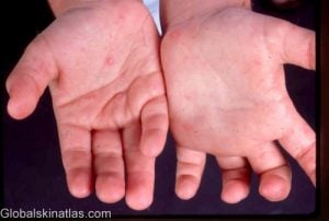 Coxsackievirus (hand, foot, and mouth disease): children< 10 years old with vesicles on pharynx, mouth, hands, feet
