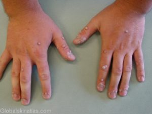 Multiple warts on the hands