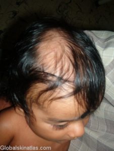 alopecia areata
