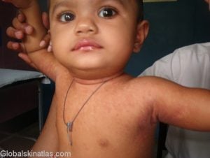 Measles (Rubeola): 4 C's: cough, coryza, conjunctivitis and cephalocaudal spread of morbilliform (maculopapular, brick red rash on face beginning at hairline then progressing to palms and soles last - rash lasts 7 days)