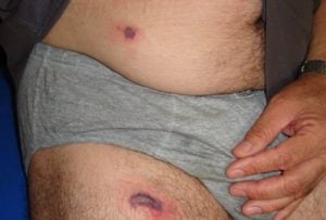 Two painful superficial ulcers with necrotic centers and red borders involved the lower abdomen and upper thigh of two days duration. The patient gave history of a spider sting one day before the appearance of the lesions. 