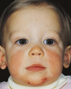 Pediatric EOR: Atopic Dermatitis | SMARTY PANCE