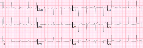 Diffuse ST elevation, without reciprocal ST depression, mostly in inferior limb leads and lateral precordial leads. This is very typical for pericarditis.