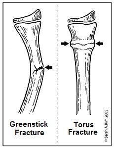 Greenstick and Torus Fractures
