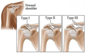 ac-joint-seperation-types