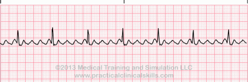 Atrial fibrillation/flutter (ReelDx) - SMARTY PANCE