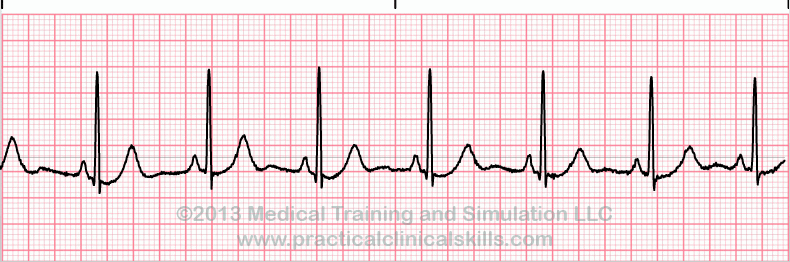 conduction-disorders-pearls-smarty-pance