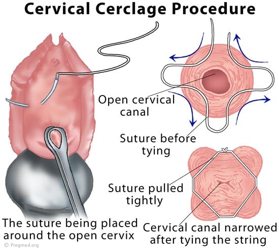 incompetent-cervix-smarty-pance