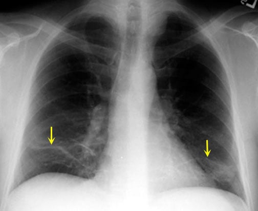 CXR demonstrating typical "plate-like" atelectasis associated with bronchiectasis