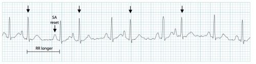 This rhythm strip displays the typical pattern of frequent PACs (arrows) separated by post-extrasystolic pauses