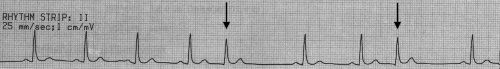 Premature QRS complexes without a preceding P wave. The QRS morphology is very similar to the sinus complexes