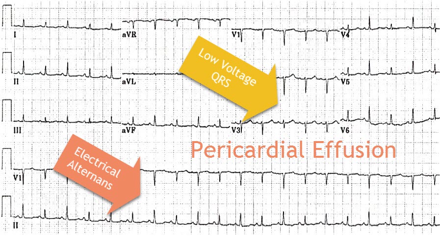 Ecg Pericardial Effusion