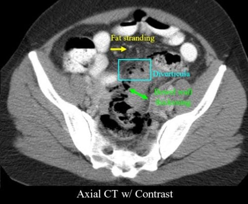 Diverticulitis with fat stranding ct scan copy