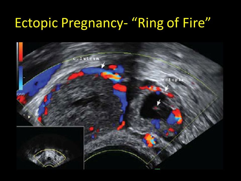 exam blueprint SMARTY Ectopic  PANCE pregnancy