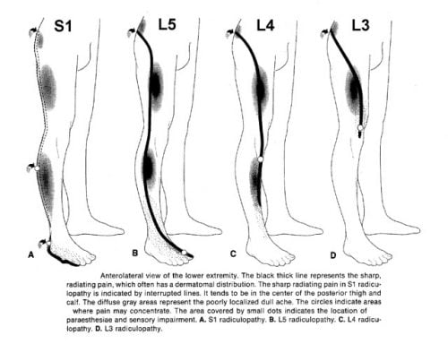 Lower Extremity Radiculopathy S1 L5 L4 and L3