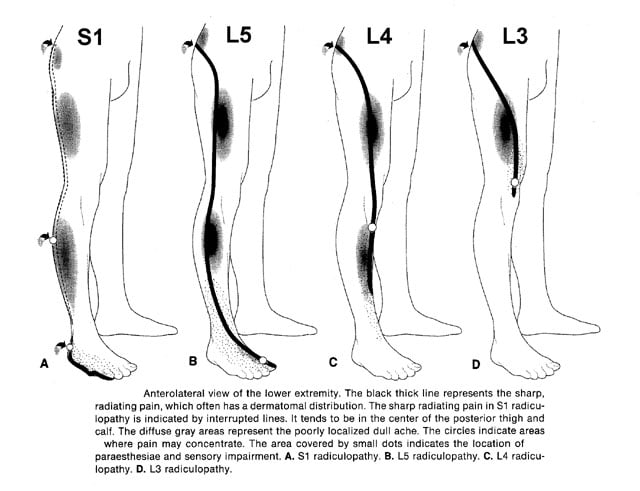 radiculopathy-rapid-review-cervical-and-lumbar-patterns-smarty-pance