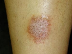 Nummular eczema