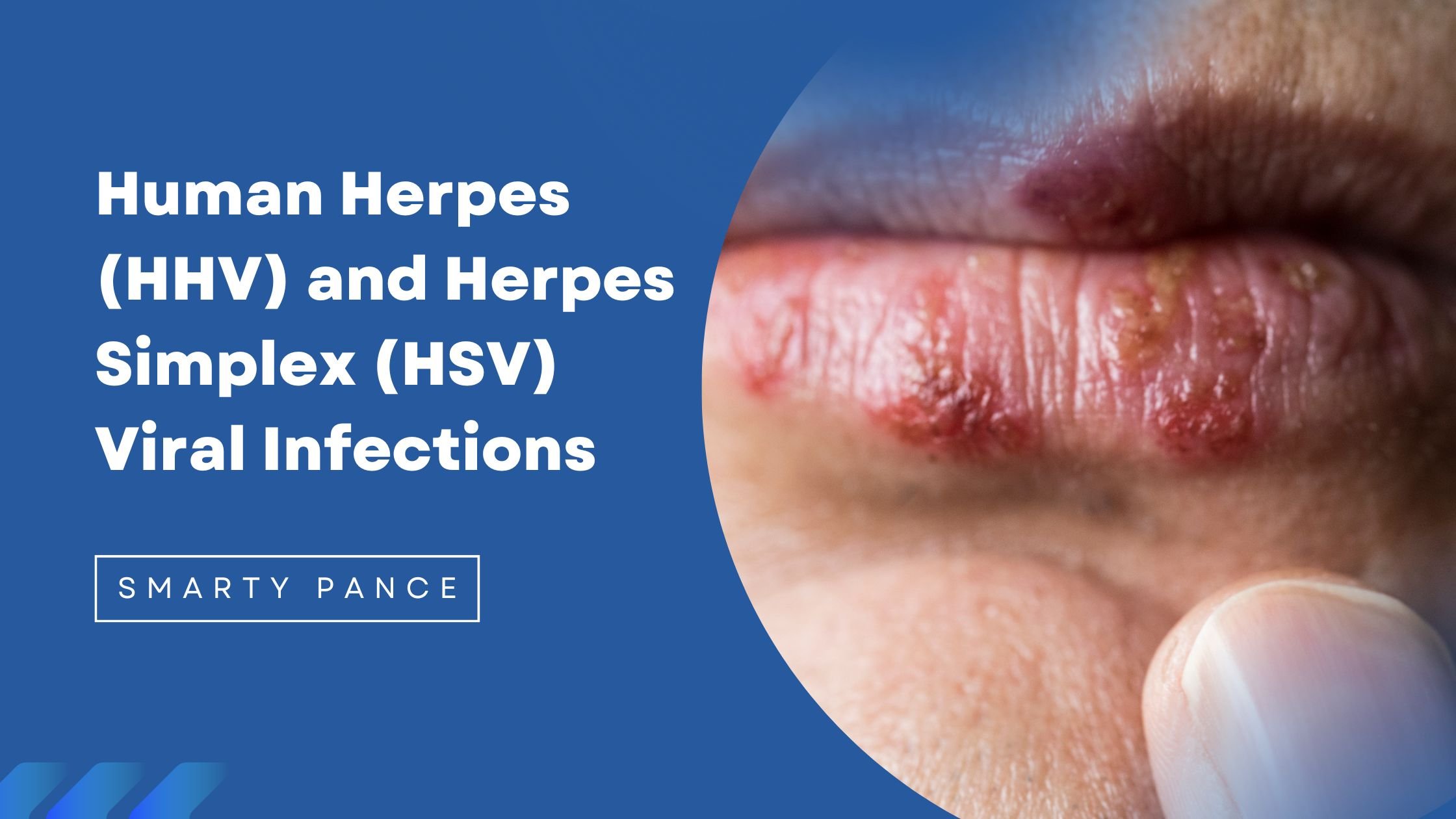 Human Herpes (HHV) and Herpes Simplex (HSV) Viral Infections