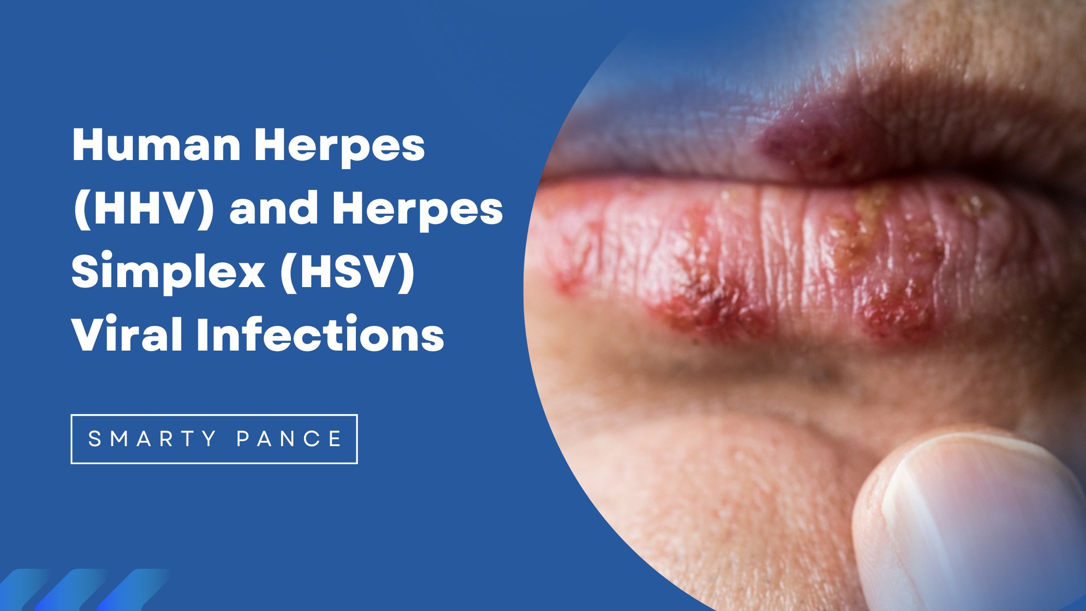 Herpes Virus Women