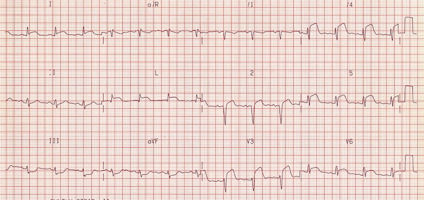 Myocardial Infarction: The Daily PANCE Blueprint - Smarty PANCE