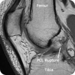 Posterior Collateral Ligament (PCL) Tear
