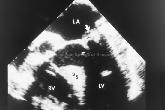 Acute And Subacute Bacterial Endocarditis Reeldx Pance And Panre Content Blueprint