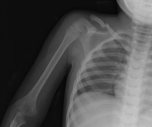 Clavicular Fracture Child