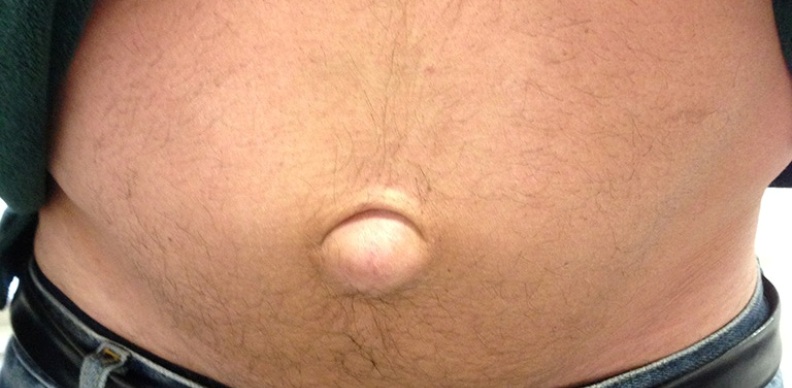 adult umbilical necrosis adult umbilical necrosis