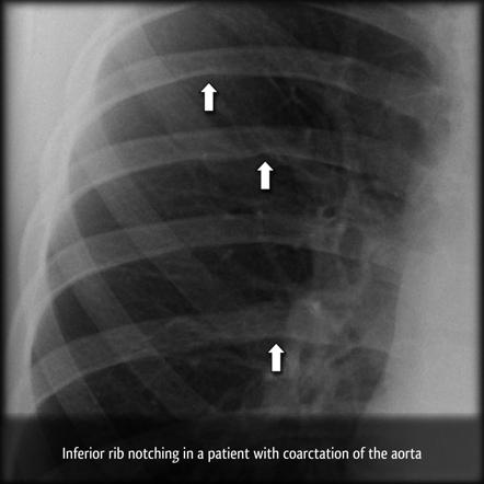 Coarctation of the Aorta: The Daily PANCE Blueprint - Smarty PANCE