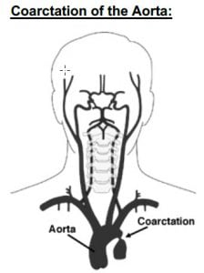Coarctation of the Aorta