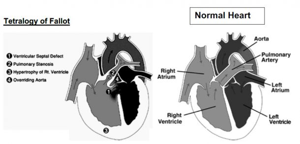 Congenital Heart Disease PEARLS | Cardiology System - Smarty PANCE