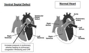 Ventral Septal Defect