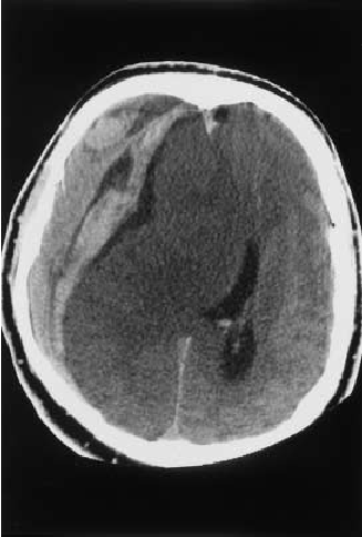 CT shows crescent shaped, concave hyperdensity