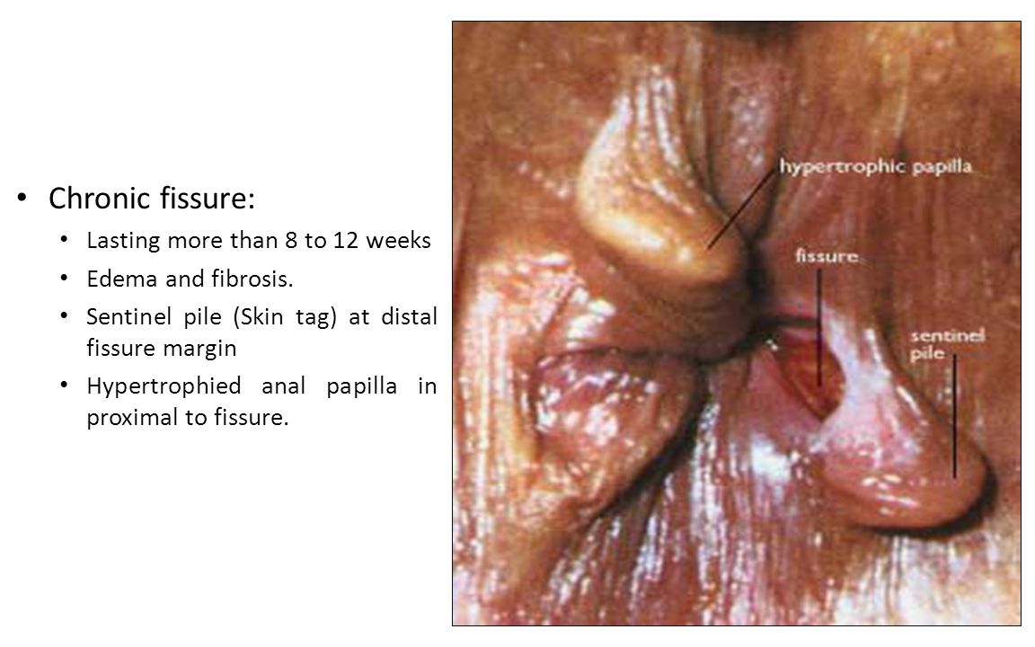 thickened mucosa) is found below the fissure. 