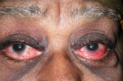 disorders of the eye (pearls)